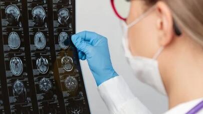 Beyin xərçənginin yeni müalicə üsulu tapıldı