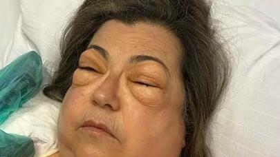 Dünyada cəmi 3 nəfərin başına gəlib: nəfəs borusu partladı və... - FOTO