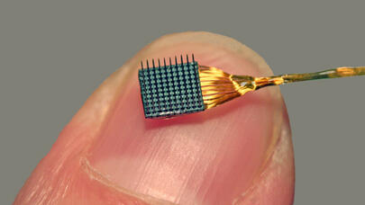 İkinci şəxsə "Neuralink" implantı qoyuldu: "400 elektrod fəaliyyət göstərir"