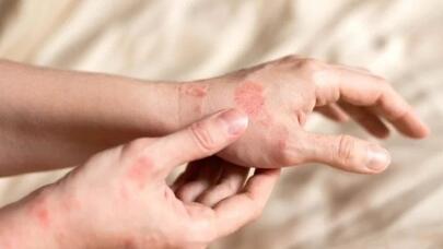 Dəri xəstəliklərinin müalicəsinə müsbət təsir edən yeni zülal tapıldı