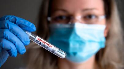 Səhiyyə Nazirliyindən meymunçiçəyi ilə bağlı AÇIQLAMA