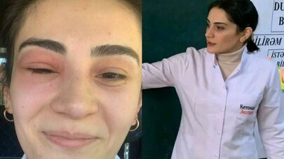 "Tək gözlə imtahandan 55 bal topladım" - Gözünü arı sancan müəllim