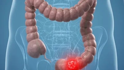 Kolon xərçəngində nələr gizlənir? - Slimlərdən gözlənilməz kəşf