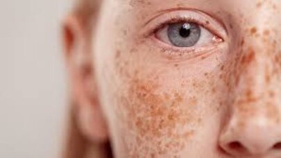 Bu qidalar dəridə tünd ləkələrə səbəb olurmuş