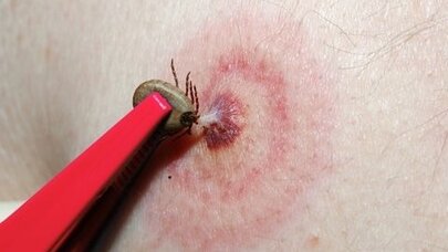 Gənədən keçən virus: Fermerin ölümü Türkiyəni təşvişə saldı