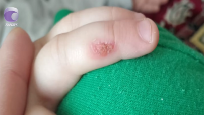 “3 yaşlı uşağım bağçada ağlayanda bıçağı qızdıraraq əlinə basıb” - VİDEO