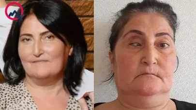 Burun əməliyyatının ağır fəsadı: Məşhur klinika təzminat ödəyəcək - FOTO