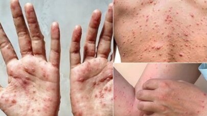 Meymunçiçəyi qayıdır? - Yeni yoluxmalar aşkarlandı
