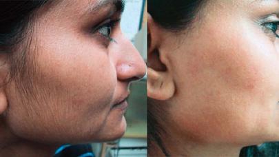 Üzdəki tükləri yox edən noxud və sarıkök maskası