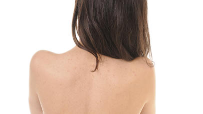 Kürəkdə çıxan sızanaqlardan xilas edən təbii üsul