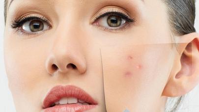 Böyük sızanaqları qurudan ən sadə üsul