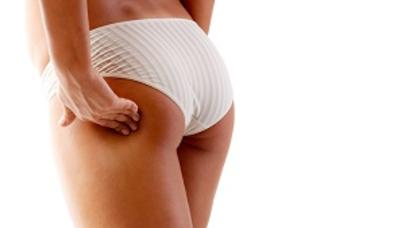 Sellülitin müalicəsində ən ucuz, amma ən təsirli üsul