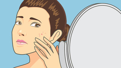 Sızanaq ləkələrini yox edən təbii üsullar