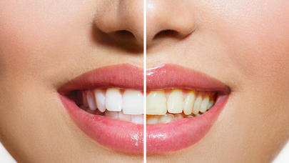 Dişləri bu yolla ağardın - FOTOLAR