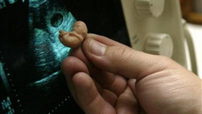 Azərbaycanda məktəbli qızların ABORT macəraları